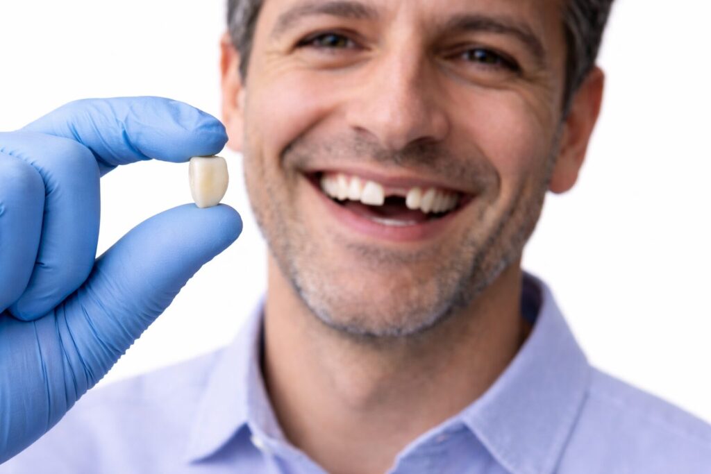 Custom dental crown prepared to replace missing front tooth at Shine Dental Associates in Syosset, NY