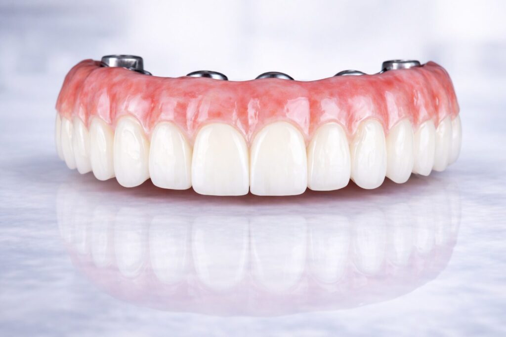 Full arch dental implant restoration with full prosthetic gum and ceramic teeth
