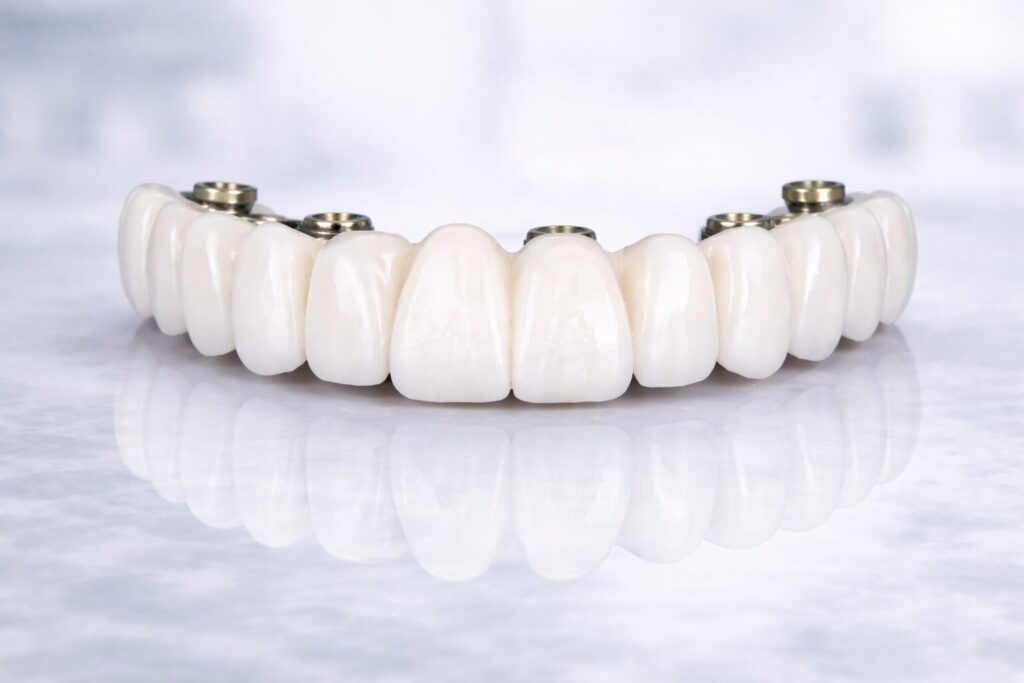 Full arch implant restoration with natural gumline showing prosthetic teeth only