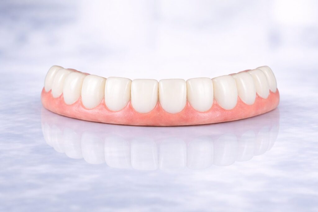 Full arch dental implant restoration with partial prosthetic gum material supporting ceramic teeth